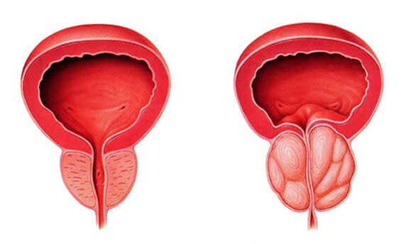Normal and inflamed prostate (prostatitis)